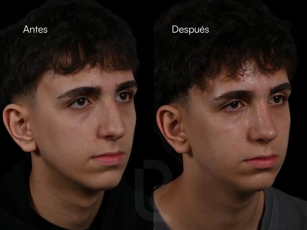 Rinoplastia caso 2